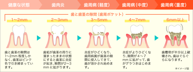 歯周病・歯肉炎ってどんな病気？