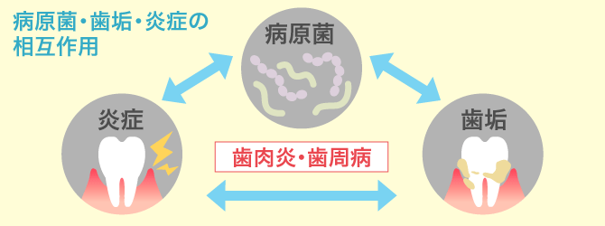 歯肉炎・歯周病