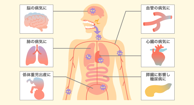 口の中だけじゃない！歯周病が引き起こす体のトラブル